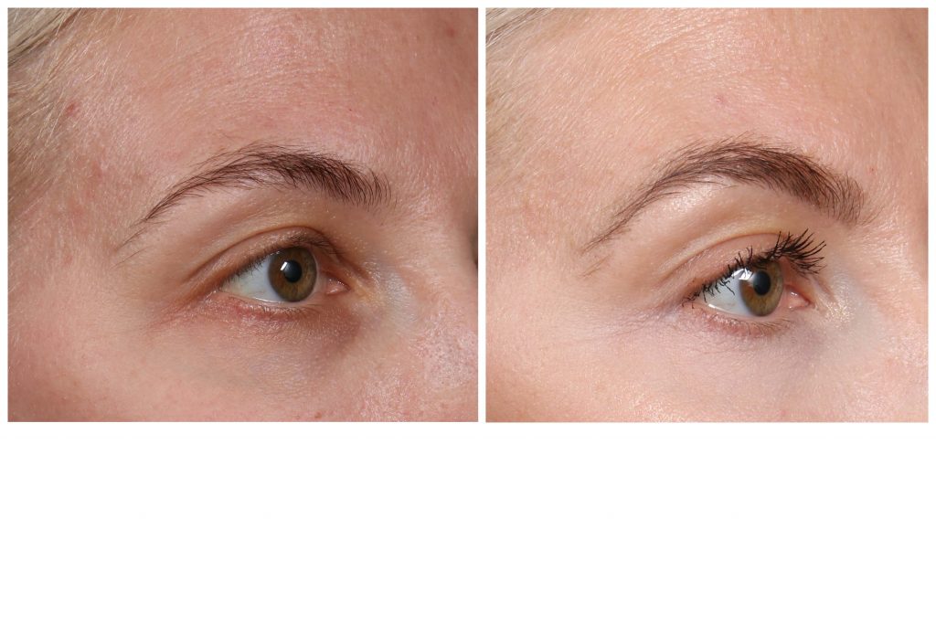 Katrina Olson Eyes before and after thermage dermapure